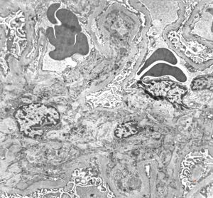 F,47y. | IgA nephropathy (Berger disease)